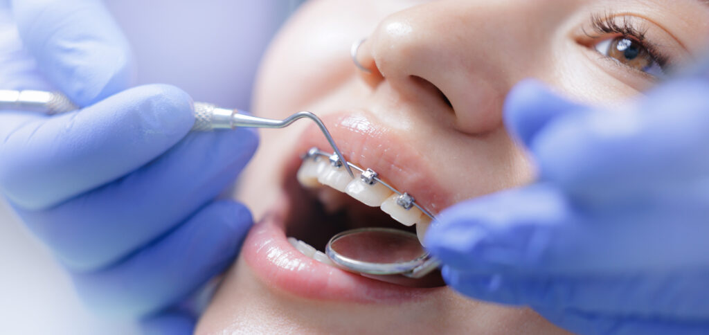 Asian female receiving orthodontic treatment with braces close-up, banner orthodontic.