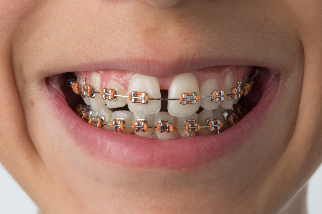 Teeth with metal dental braces close up