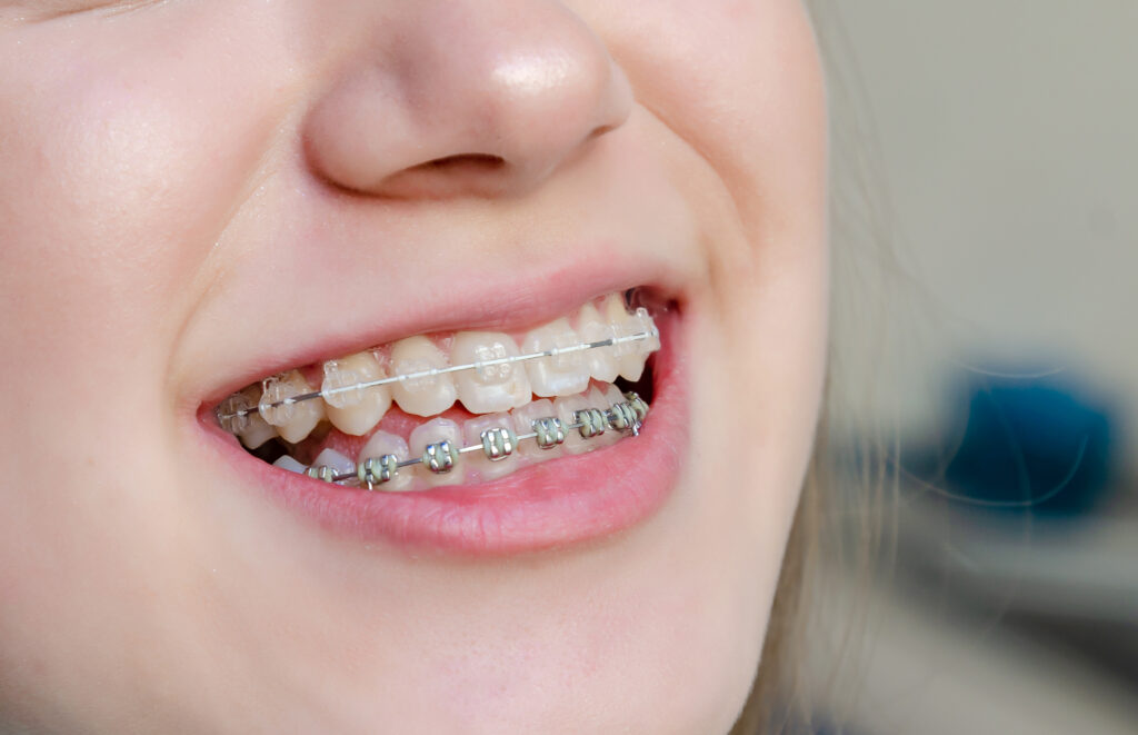 Braces are set on the teeth, girl's smile. Bite Correction.