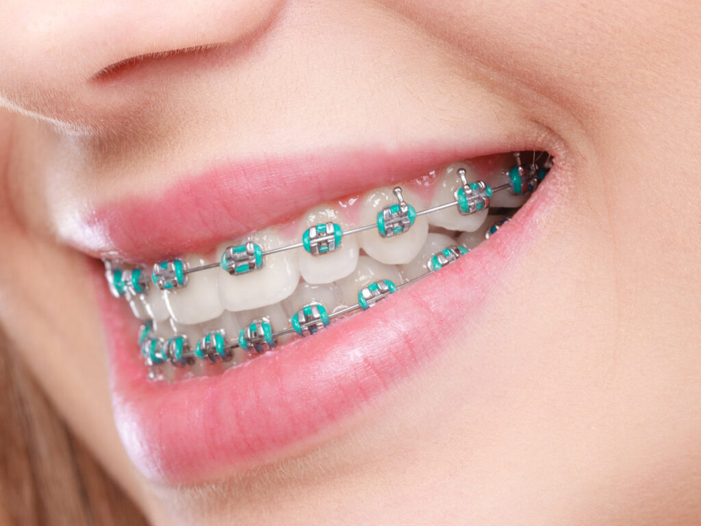 Dentist and orthodontist concept. Closeup of woman smile showing teeth with blue braces