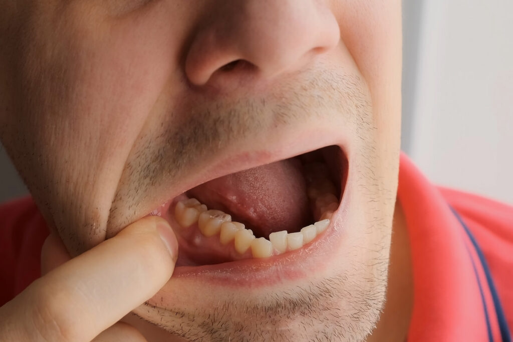 Man is showing tooth in mouth with a dental abscess fistula on gum, closeup view. Tooth with a temporary filling seal. Caries dental concept. Dental treatment of the internal parts of the tooth.